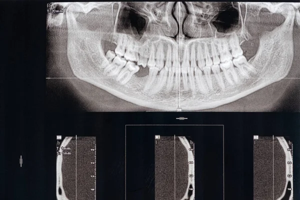 Tomografia Computadorizada Paciente Com Dente Mastigatório Ausente Oclusão — Fotografia de Stock
