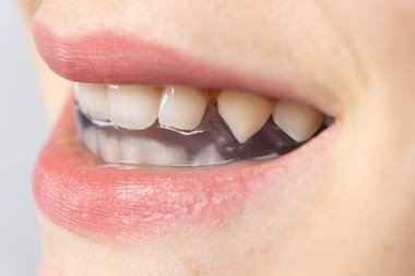 Ağız koruyucusu, çenenin kaslarını gevşetmek için temporomandibular eklemlerin, bruxism, malocclusion, işlev bozukluğu tedavisi için ağızda sabitleme