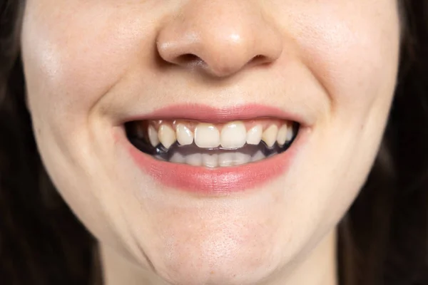 Stomatologiczny Ochraniacz Zęby Szyna Jamie Ustnej Leczenia Dysfunkcji Stawów Skroniowo — Zdjęcie stockowe