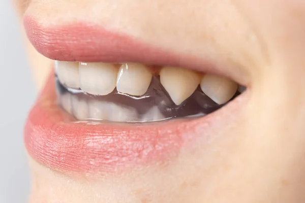 Protetor Bucal Dentário Tala Boca Para Tratamento Disfunção Das Articulações — Fotografia de Stock