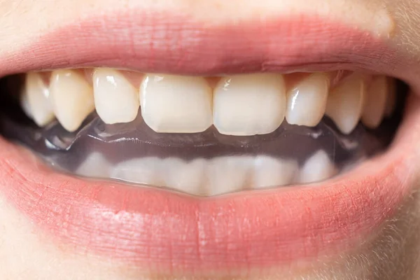 Protetor Bucal Dentário Tala Boca Para Tratamento Disfunção Das Articulações — Fotografia de Stock