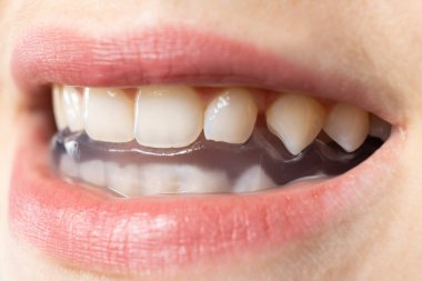 Ağız koruyucusu, çenenin kaslarını gevşetmek için temporomandibular eklemlerin, bruxism, malocclusion, işlev bozukluğu tedavisi için ağızda sabitleme