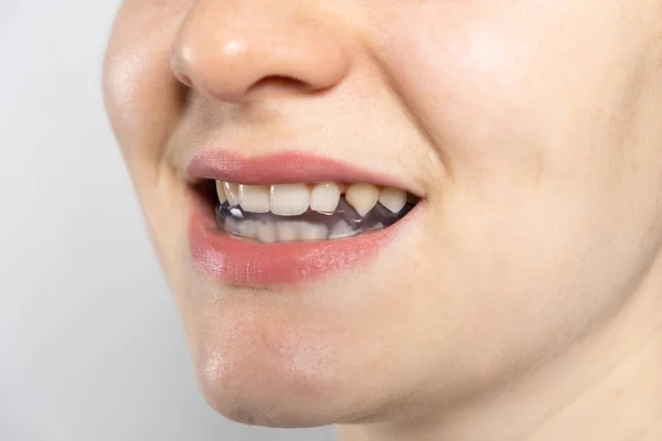 Stomatologiczny Ochraniacz Zęby Szyna Jamie Ustnej Leczenia Dysfunkcji Stawów Skroniowo — Zdjęcie stockowe