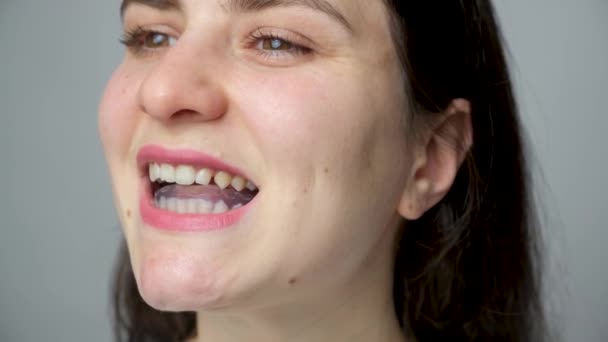 Zahnschutz Schiene Mund Zur Behandlung Von Kiefergelenkstörungen Bruxismus Malokklusion Die — Stockvideo