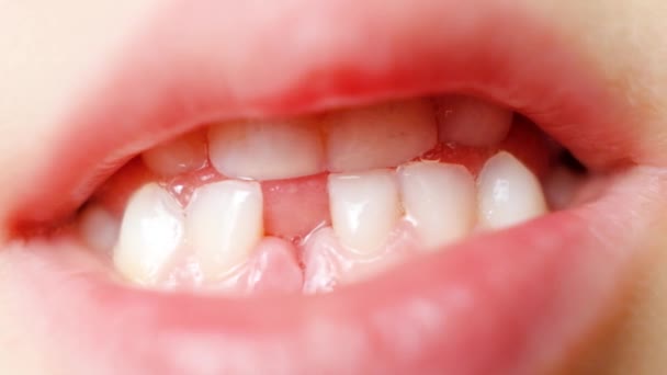 儿童丧失乳牙 一个六岁的小孩露出了第一颗掉出来的乳牙 — 图库视频影像