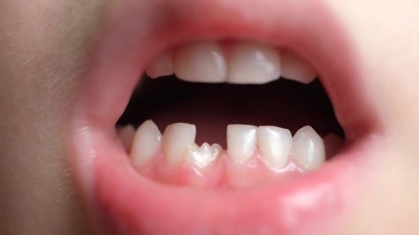 Зубы Шестилетнего Ребенка Криво Растущий Резец Вместо Потерянного Молочного Зуба — стоковое видео
