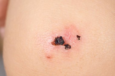 Küçük bir çocuğun dizindeki derinin iyileşmesi asfalta düştükten sonra yaralanması.