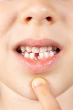 Çocuklarda süt dişi kaybı. Altı yaşındaki bir çocuk ilk düşen bebek dişini gösteriyor..