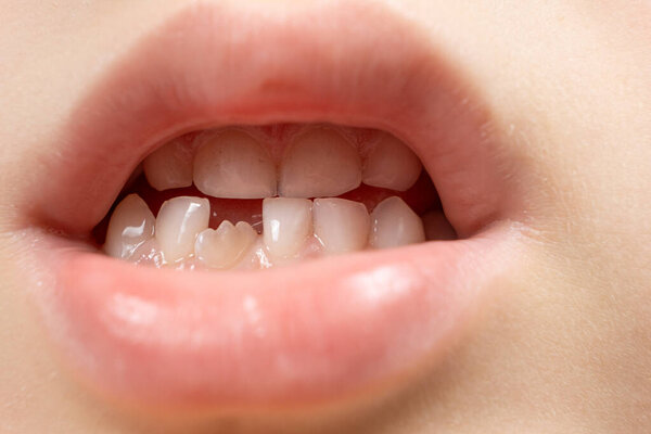 The teeth of a six-year-old child, a crookedly growing incisor in place of a lost milk tooth