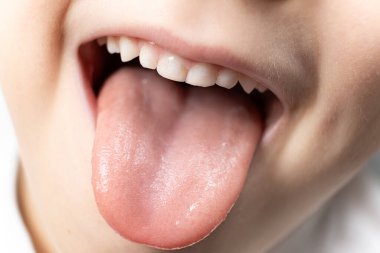 Altı yaşında sağlıklı bir çocuğun dili, dilinde papillae..