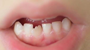 Altı yaşındaki bir çocuğun dişleri, eğri büğrü büğrü büyüyen bir ön dişin yerine kayıp bir süt dişi.