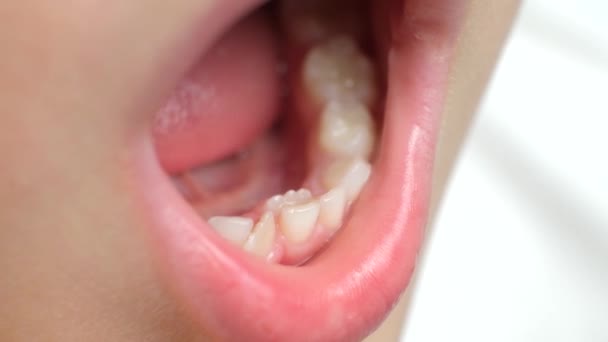 Krokigt Växande Tänder För Att Ersätta Mjölktänder Hos Ett Barn — Stockvideo
