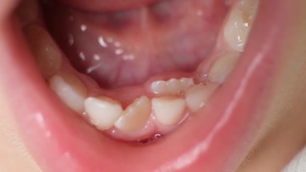 Krzywo Rosnące Zęby Zastąpić Zęby Mleczne Dziecka Drugi Rząd Zębów — Wideo stockowe