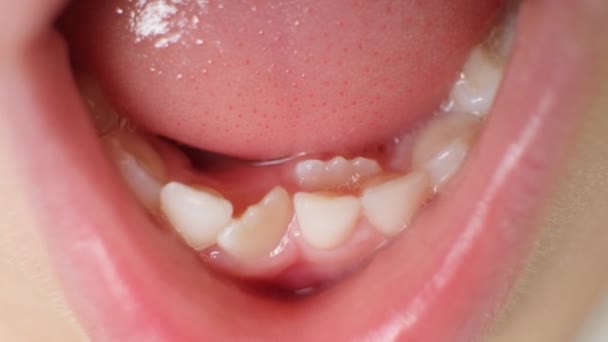 Denti Che Crescono Storti Sostituire Denti Latte Bambino Seconda Fila — Video Stock