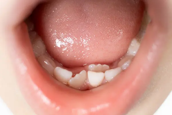 stock image Crookedly growing teeth to replace milk teeth in a child. The second row of teeth, the tooth grows while the incisor has not yet fallen out