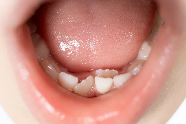 Dentes Crookedly Crescente Para Substituir Dentes Leite Uma Criança Segunda Fotos De Bancos De Imagens Sem Royalties