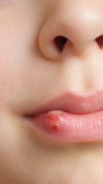 Deri hasarı, yara, küçük bir çocuğun dudağında sıyrık.