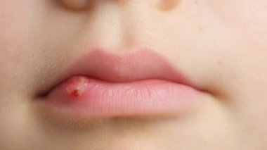 Deri hasarı, yara, küçük bir çocuğun dudağında sıyrık.