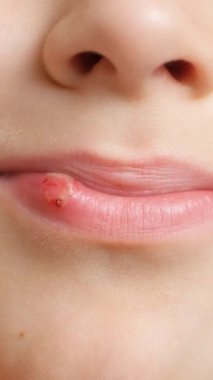 Deri hasarı, yara, küçük bir çocuğun dudağında sıyrık.