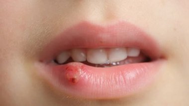 Deri hasarı, yara, küçük bir çocuğun dudağında sıyrık.