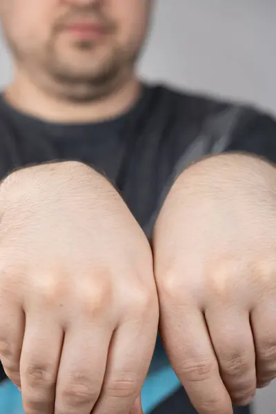 stock image Comparison of healthy arm and arm with wrist ganglion cyst