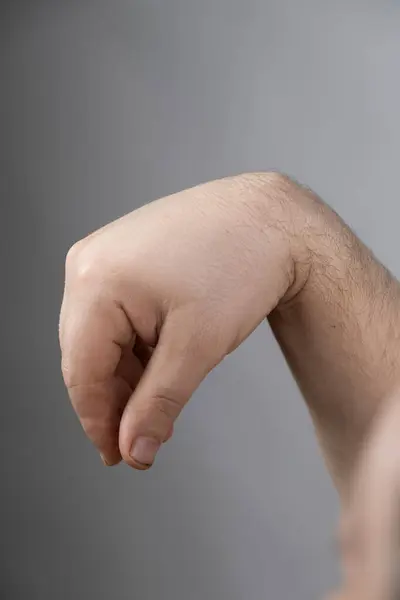 stock image Ganglion cyst or hygroma of the wrist on the hand of a male patient.