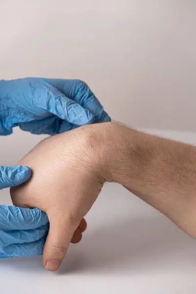 stock image Ganglion cyst or hygroma of the wrist on the hand of a male patient, examination by a doctor.