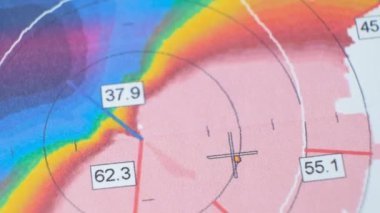 Keratoconus 'lu bir hastada korneanın kalınlığı ve eğriliğinin incelenmesinin sonuçları.