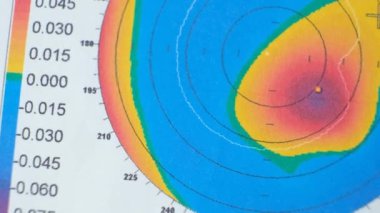 Keratoconus 'lu bir hastada korneanın kalınlığı ve eğriliğinin incelenmesinin sonuçları.