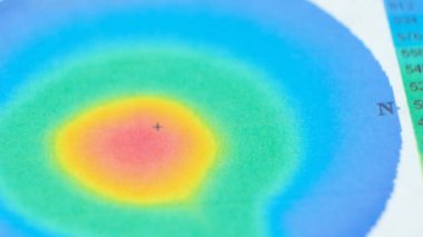 Keratoconus 'lu bir hastada korneanın kalınlığı ve eğriliğinin incelenmesinin sonuçları.