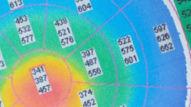 Keratoconus 'lu bir hastada korneanın kalınlığı ve eğriliğinin incelenmesinin sonuçları.