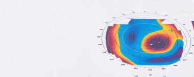 Keratoconus 'lu bir hastada korneanın kalınlığı ve eğriliğinin incelenmesinin sonuçları.