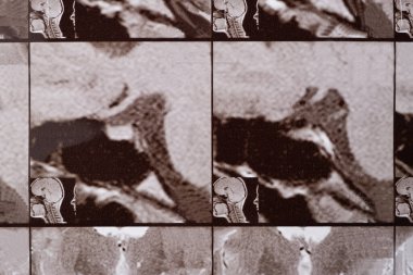 Sağlıklı bir insanın kafasının manyetik rezonans görüntüsü, hipofiz bezinin görüntüsü.