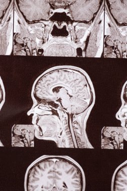 Sağlıklı bir insanın kafasının manyetik rezonans görüntüsü, hipofiz bezinin görüntüsü.