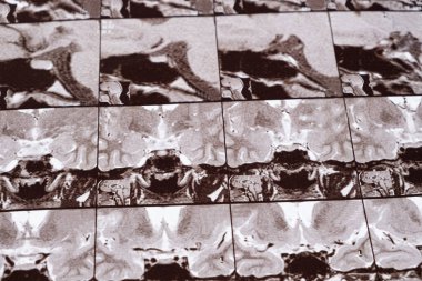 Sağlıklı bir insanın kafasının manyetik rezonans görüntüsü, hipofiz bezinin görüntüsü.