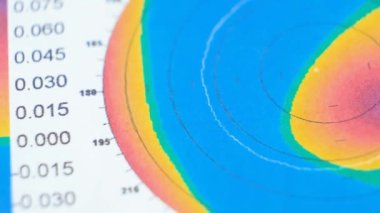 Keratoconus 'lu bir hastada korneanın kalınlığı ve eğriliğinin incelenmesinin sonuçları.