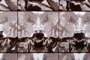 Sağlıklı bir insanın kafasının manyetik rezonans görüntüsü, hipofiz bezinin görüntüsü.