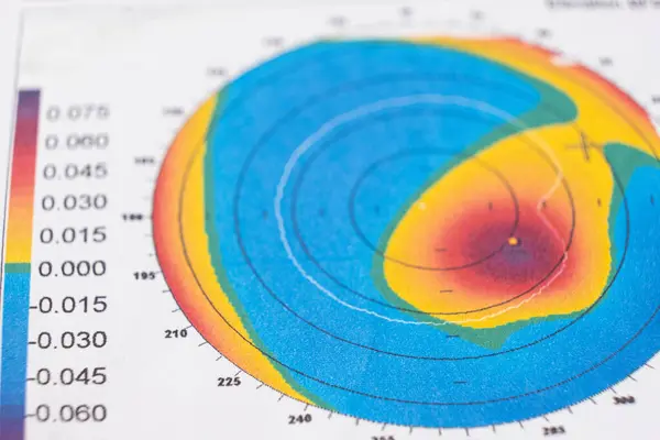 stock image Results of the examination of the thickness and curvature of the cornea in a patient with keratoconus