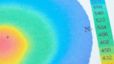 Keratoconus 'lu bir hastada korneanın kalınlığı ve eğriliğinin incelenmesinin sonuçları.