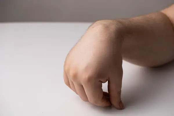 stock image Ganglion cyst or hygroma of the wrist on the hand of a male patient.