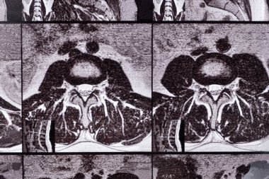 Omurgalar arası disk çıkıntısı ve göğüs omurgasında osteokondrosis olan bir hastanın MR 'ı..