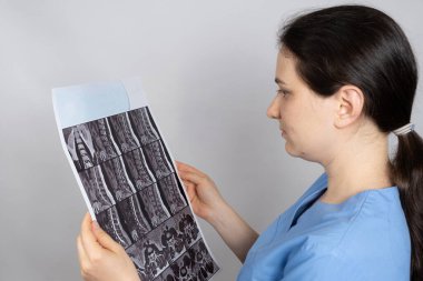 Doktorun elinde omurgaları arasında çıkıntı ve göğüs kemiğinde osteoartrit olan bir hastanın MRI görüntüsü var.