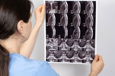 Doktorun elinde omurgaları arasında çıkıntı ve göğüs kemiğinde osteoartrit olan bir hastanın MRI görüntüsü var.