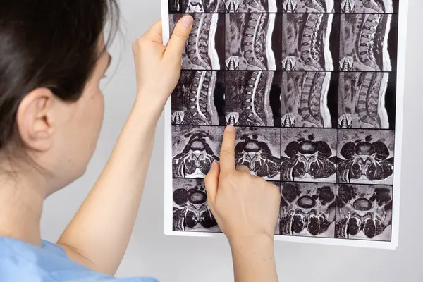 Doktorun elinde omurgaları arasında çıkıntı ve göğüs kemiğinde osteoartrit olan bir hastanın MRI görüntüsü var.