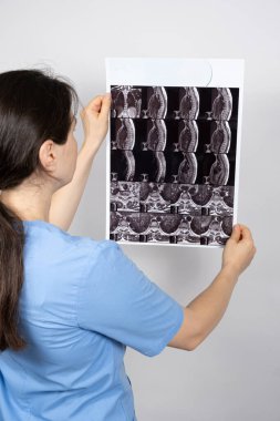 Doktorun elinde omurgaları arasında çıkıntı ve göğüs kemiğinde osteoartrit olan bir hastanın MRI görüntüsü var.