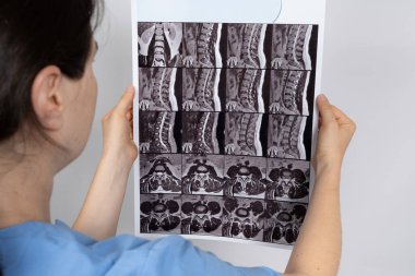 Doktorun elinde omurgaları arasında çıkıntı ve göğüs kemiğinde osteoartrit olan bir hastanın MRI görüntüsü var.