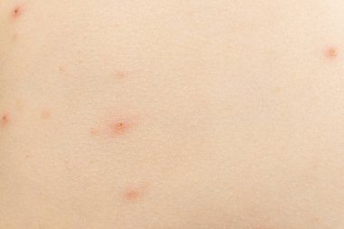 Suçiçeği olan makro deri, farklı aşamalarda Vesicles.