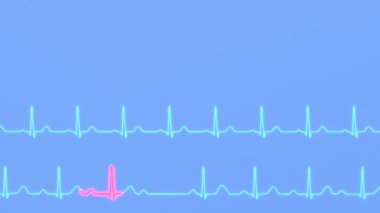 Kalp ritmi ve AV blok EKG karşılaştırması..