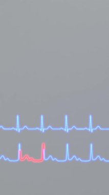 Kalp ritmi ve AV bloğunun EKG karşılaştırması. Dikey canlandırma 3B canlandırmasıName