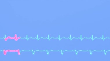 Kalp aritmilerinin EKG 'si. Sağ bohça dal bloğu ve sol bohça dal bloğu